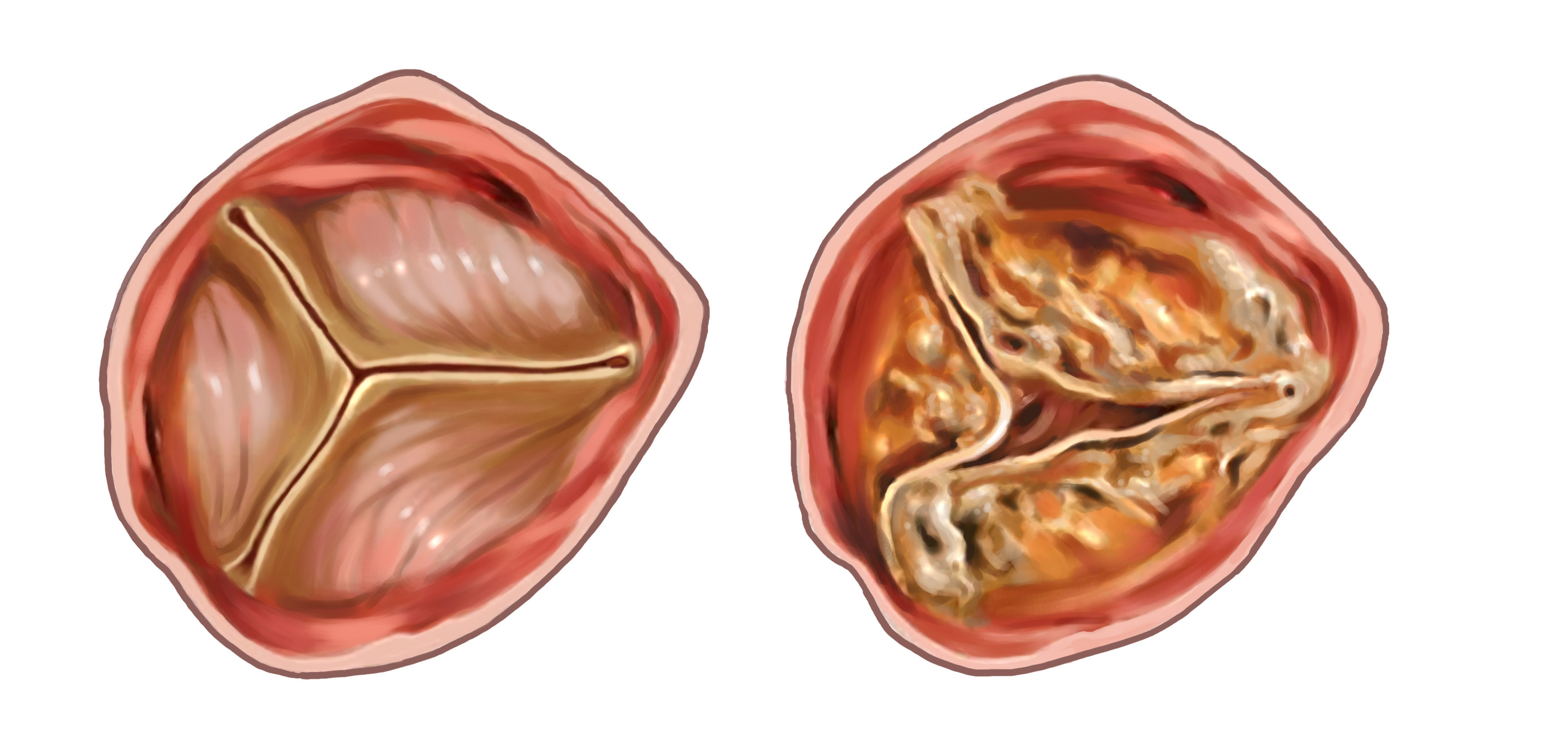 Aortic Stenosis The Keyhole Heart Clinic