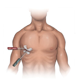 Keyhole approach to mitral valve
