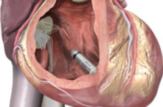Leadless Pacemaker In Place