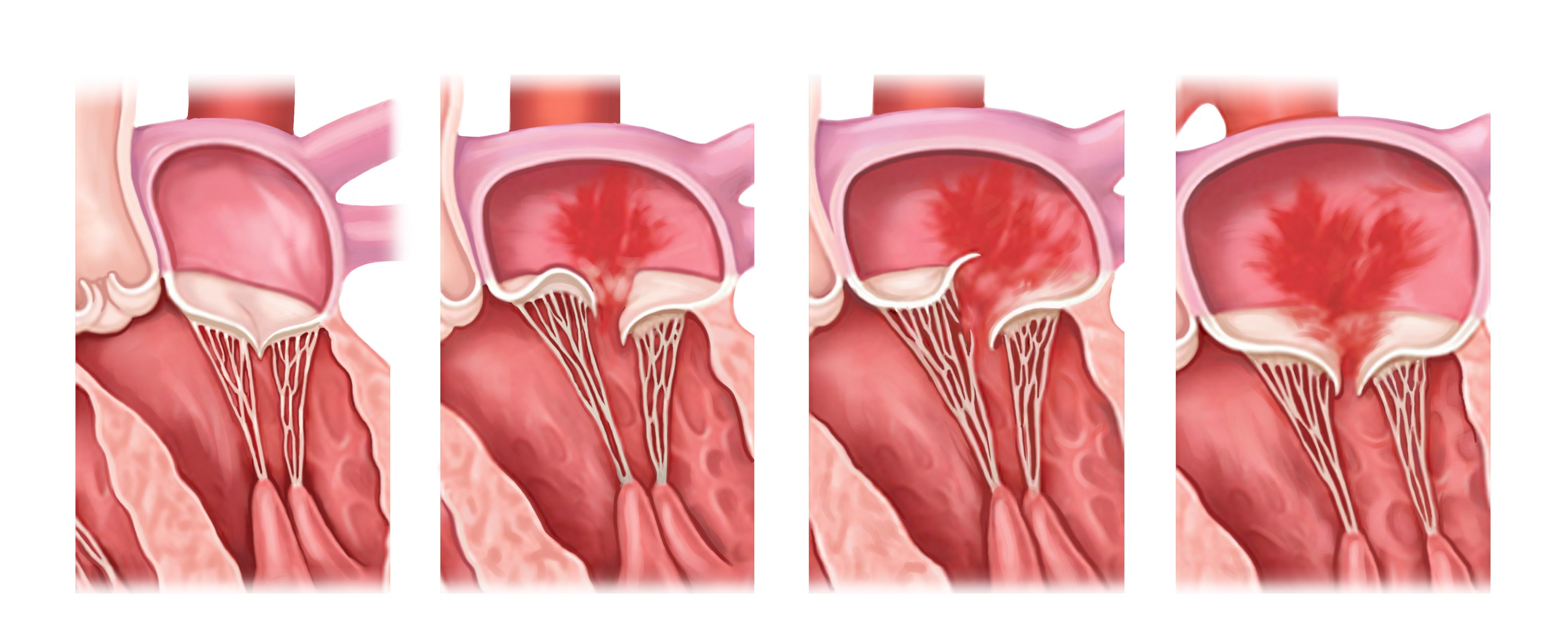 How to Recognize a Leaking Heart Valve How to Recognize a Leaking Heart Valve new pics How to Recognize a Leaking Heart Valve How to Recognize a Leaking Heart Valve new photo