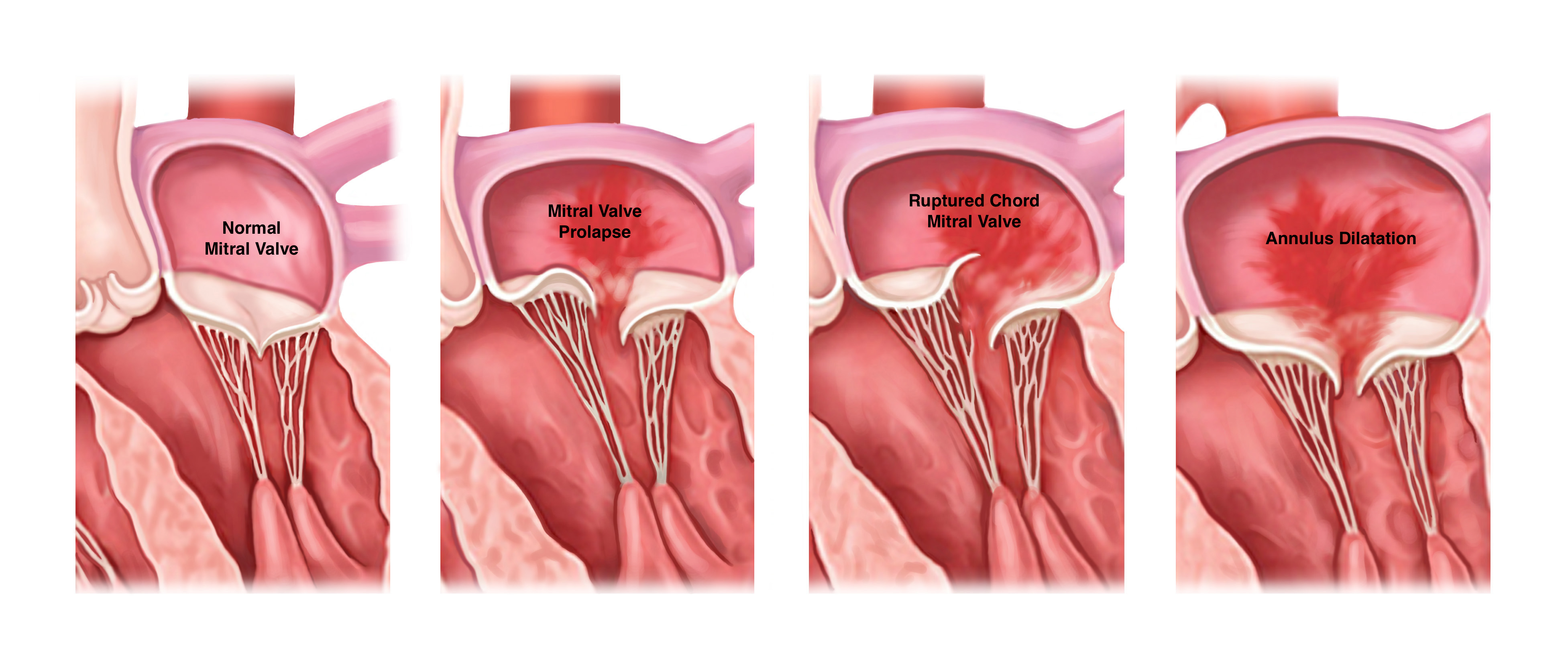 Mitral Valve Regurgitation