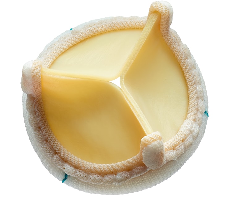 Keyhole Aortic Valve Surgery, Recover In Days After Surgery