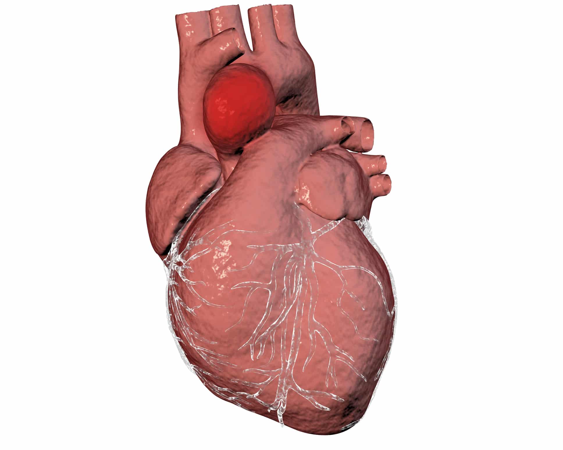 Bicuspid Aortic Valve Disease Be Dangerous Keyhole Heart Clinic