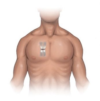 Minimally invasive aortic valve