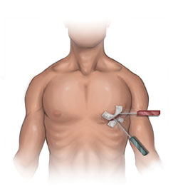 Keyhole heart clinic chest