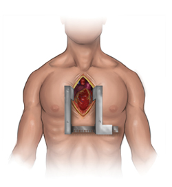 Keyhole heart clinic chest open diagram
