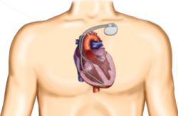 pacemaker in chest