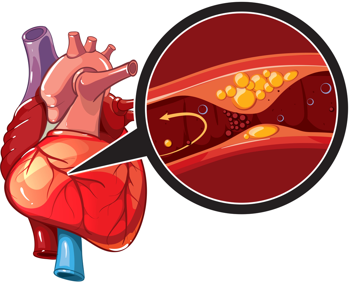 Coronary Artery Disease: Treatment, Causes & Prevention