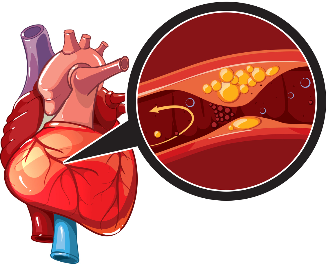 essay about coronary heart disease