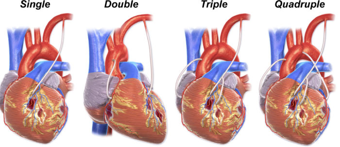 Triple Bypass Surgery Zollatry 