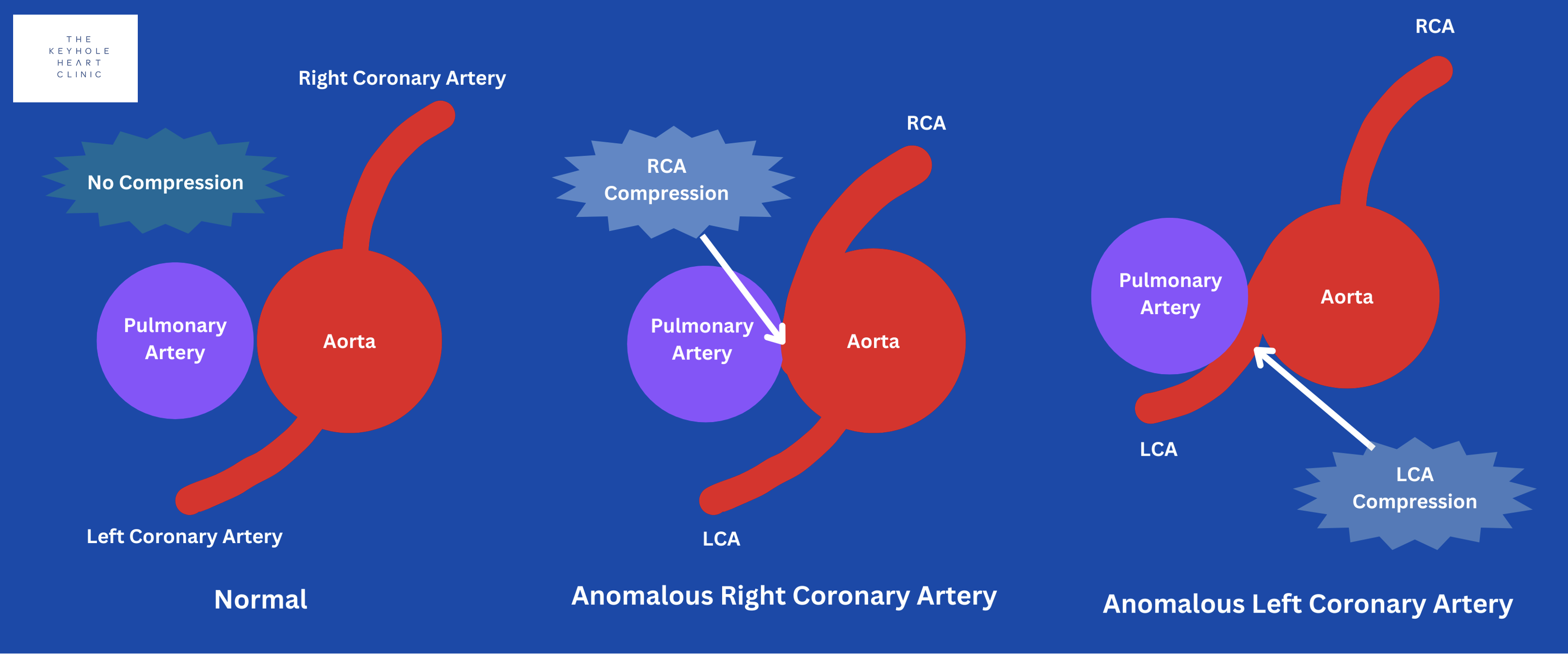 The Danger Of Anomalous Coronary Artery Anatomy The Keyhole Heart Clinic