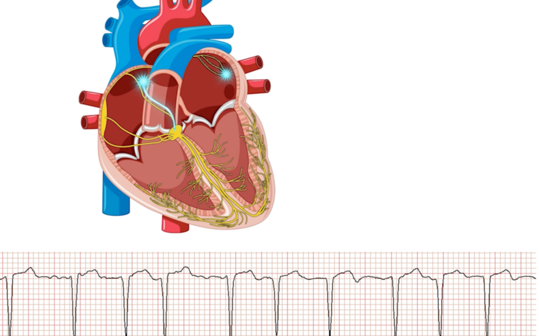 Atrial Fibrillation: Why Awareness and Treatment Now Will Save Your Heart and Prevent Strokes