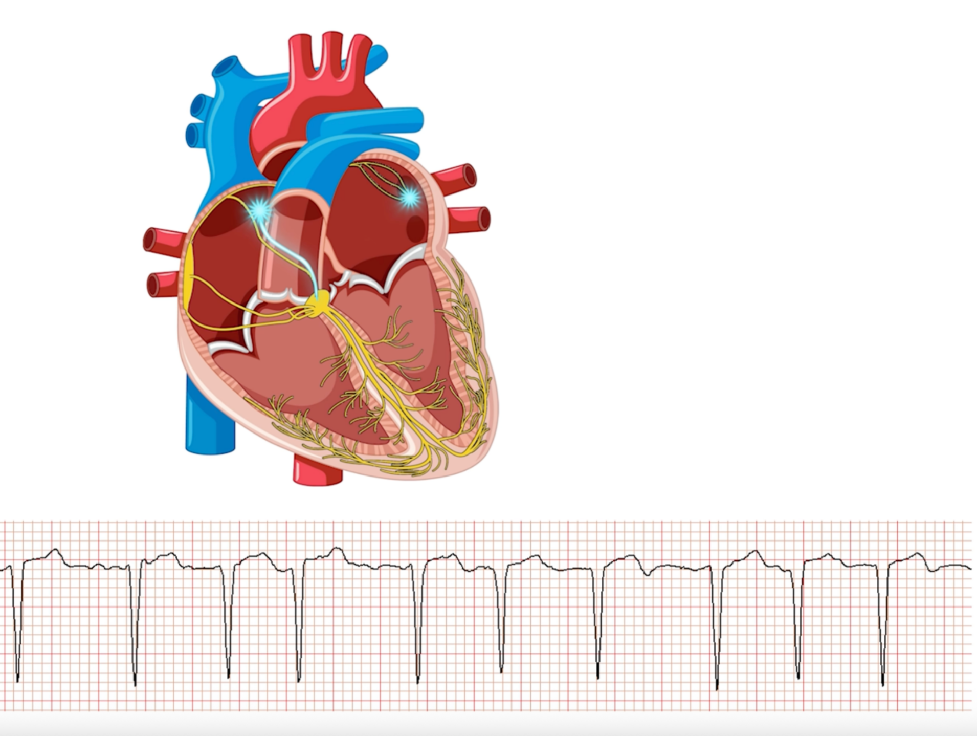 Heart in atrial fibrillation with ECG