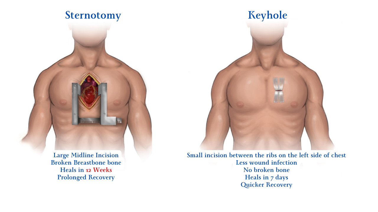 Copy of Keyhole Heart Bypass (1) Keyhole heart clinic chest