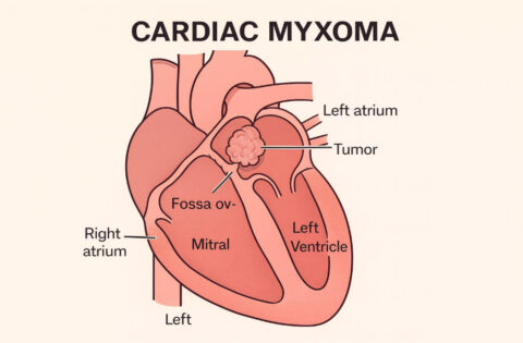 cardiac-myxoma-benign-heart-tumour-recovery-with-keyhole-treatment