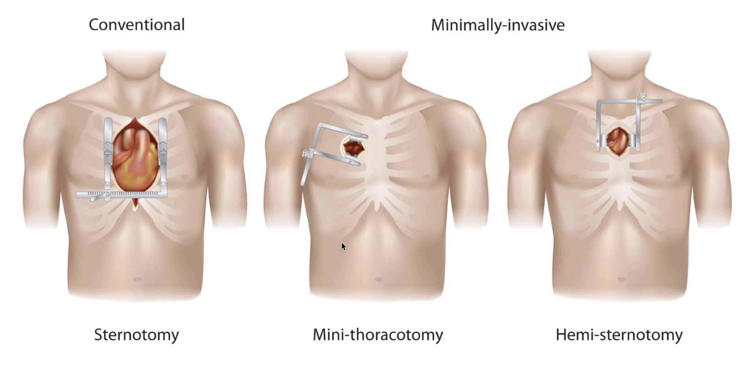 Illustration comparing keyhole aortic valve replacement with conventional open-heart surgery for aortic stenosis